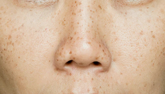How to get rid of dark spots: Your complete guide