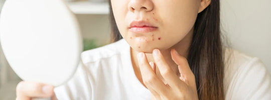 Acne around mouth? Here’s How to treat it