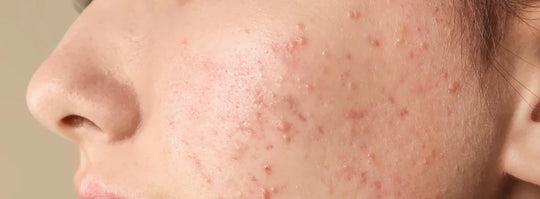 6 causes of adult acne and possible ways to get rid of it