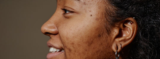 Are acne scars permanent? Let’s find out